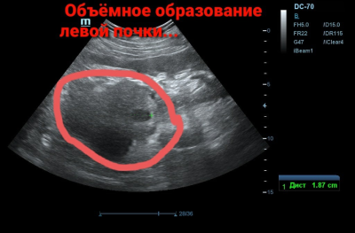 Объемное образование левой почки